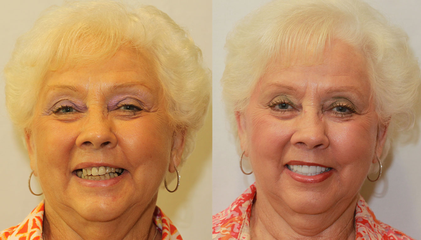 full mouth rejuvenation before and after pictures of female patient