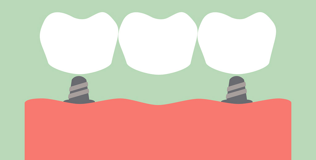 clip art showing how a dental bridge works