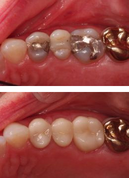 before picture showing metal fillings in teeth, after picture shows teeth with porcelain fillings